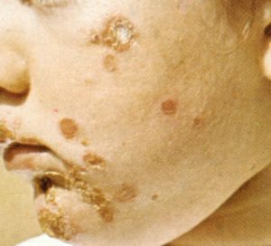 Manifestazioni cliniche tipiche della impetigine bollosa